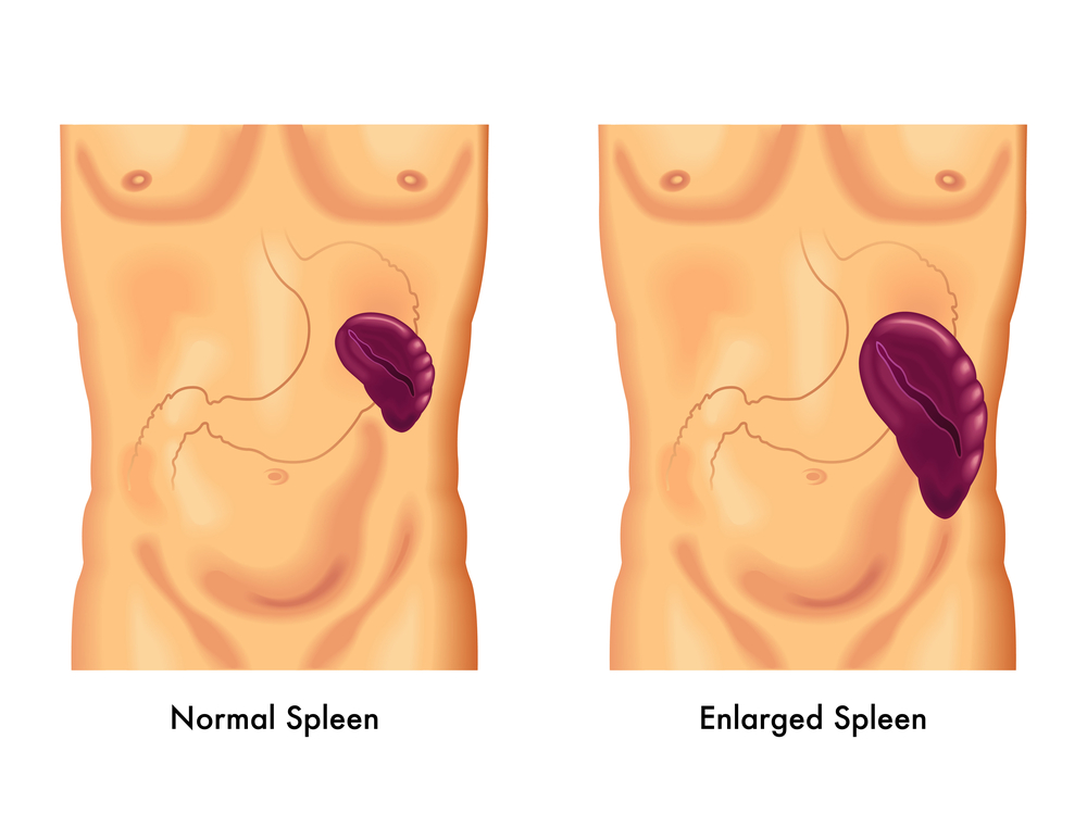 Caring for your spleen